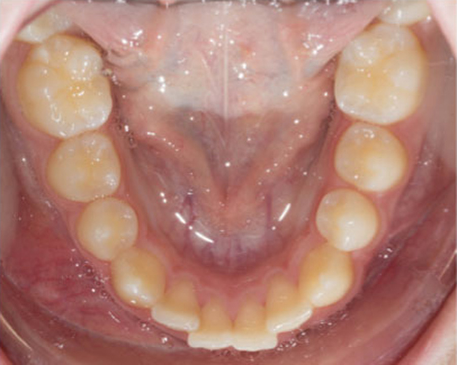 Interior mandibula inferior