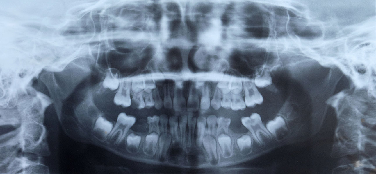 Radiografía dental de un niño